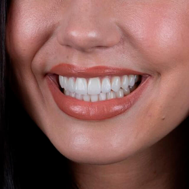 Gepflegter Mund mit weißen Zähnen - nach Behandlung mit Veneers