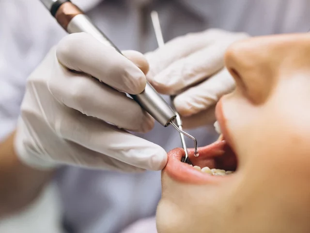 Karies Behandlung – Karies am Zahn vom Zahnarzt behandeln lassen