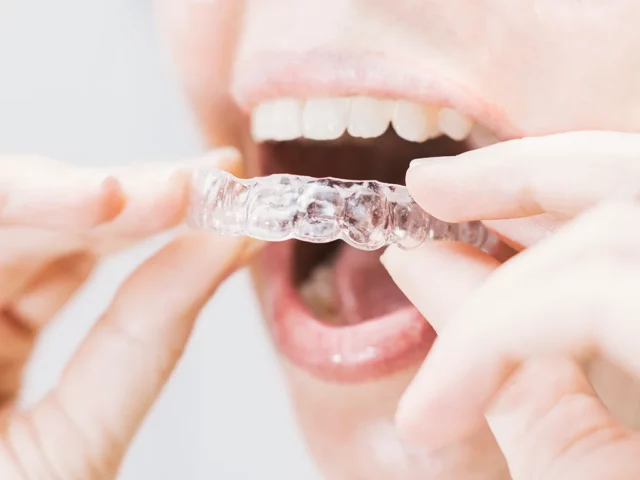 Überbiss korrigieren – durchsichtige Zahnschiene