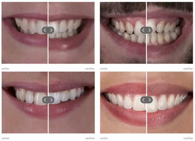 Aligner vorher nachher – beeindruckende Beispiele aus unserer Zahnarztpraxis Discover White