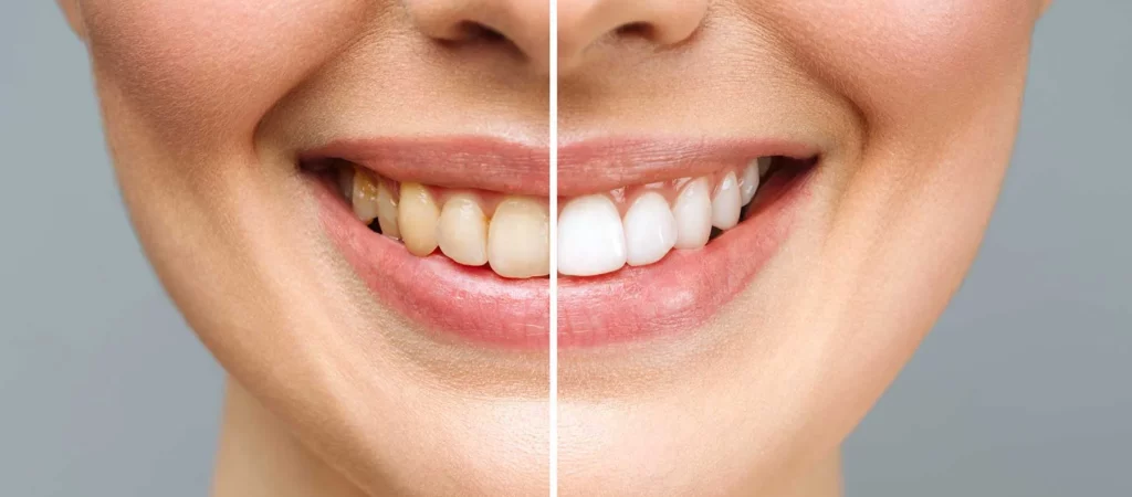 Zahnverfärbungen – Zähne verfärben sich schnell: Vorher nachher Beispiel Zahnaufhellung