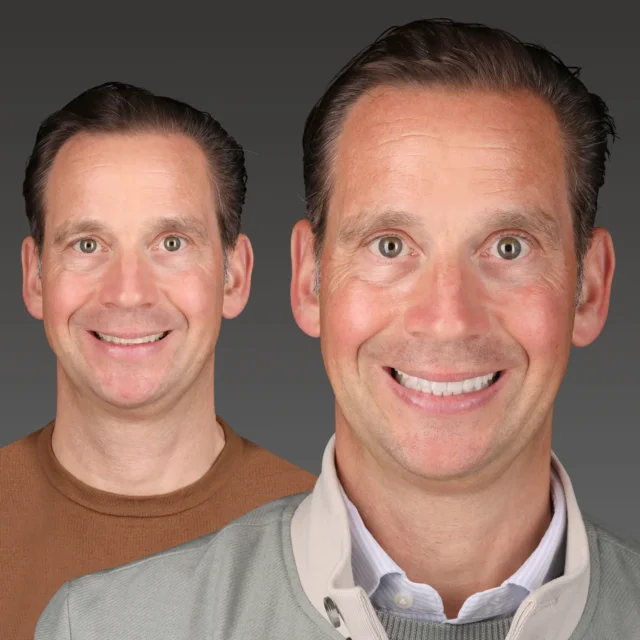 Veneers Beispiel vorher nachher – Beitragsbild
